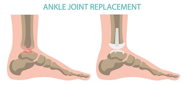 ankle joint replacement graphic